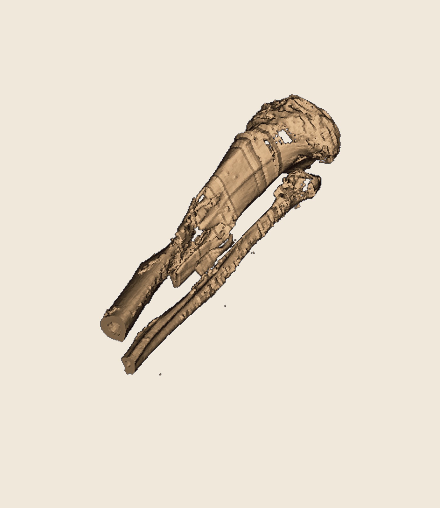 Grauballemandens skinnebensbrud